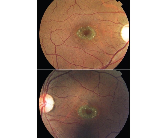 FIG.7 Retinografia de doença de Stargardt, olho direito e esquerdo (imagem superior e inferior, respetivamente).