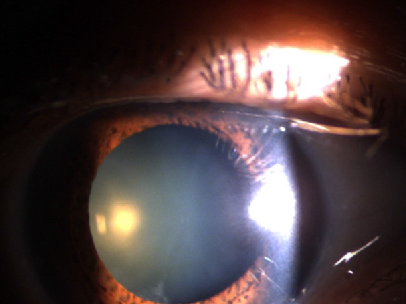 FIG.3 Fotografia externa do olho mostrando uma catarata.