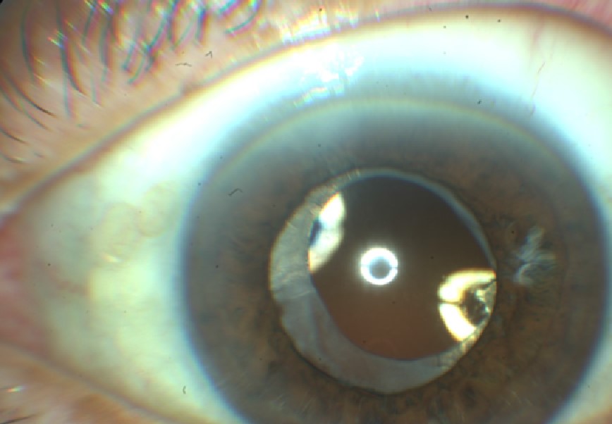 FIG.4 Fotografia externa do olho após substituição do cristalino por uma lente intraocular no contexto de cirurgia de catarata.